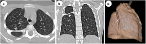 a) Imagen axial y b) coronal de la TC de tórax con visualización de la costilla intratorácica (puntas de flecha); c) TC con reconstrucción 3 D del pulmón derecho que muestra la compresión del parénquima pulmonar por la costilla intratorácica (flechas). TC: tomografía computarizada.