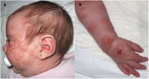 A)Niña de un mes con mastocitosis cutánea difusa. B)Placas infiltrativas con aspecto de piel de naranja con ampollas locales y costra.