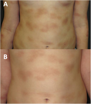 A)La misma niña con múltiples placas infiltrativas en la piel antes del tratamiento con imatinib. B)La paciente en tratamiento con imatinib a los 20meses de seguimiento.