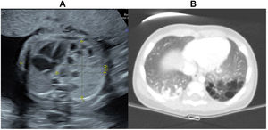 Imagen de ecografía prenatal (A) y TC posnatal (B) de MCVAP tipo2 en el lóbulo inferior izquierdo.