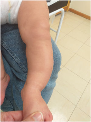 Asimetría de la pierna izquierda con curvatura pronunciada.