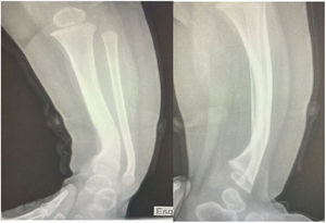 Engrosamiento cortical con adelgazamiento de la cavidad medular, sugerente de displasia tibial con pseudoartrosis congénita.
