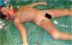 Afectación cutánea implicando aproximadamente el 60% de la superficie corporal total.