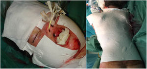Suprathel® aplicado sobre las lesiones ampollosas, cubierto de gasa grasa y vendaje estéril, sobre distintas superficies corporales en la cara (izquierda) y pecho/espalda (derecha).