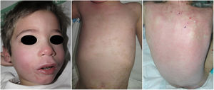 Resultados cosméticos, 4 semanas después del tratamiento. Reepitelización completa de la cara (izquierda), pecho (centro) y espalda (derecha).