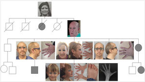 Árbol genealógico en familia con TRPS. En la radiografía simple de mano y muñeca izquierda del caso índice se observan las epífisis de las falanges en forma de cono (flechas).