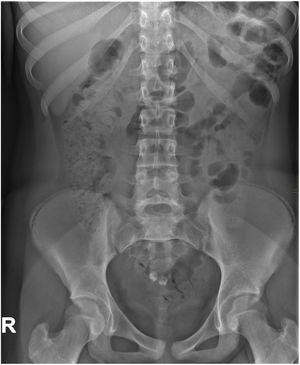 Radiografía simple anteroposterior de abdomen que muestra 2 imágenes con densidad calcio y forma de pieza dentaria en hipogastrio.