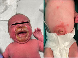 El recién nacido se mostró irritable, con costras melicéricas en torno a la boca y exudado purulento en el ombligo y las conjuntivas.