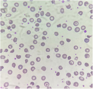 Frotis de sangre periférica con numerosos picnocitos y equinocitos contraídos e hiperdensos (aumento original: 500x).