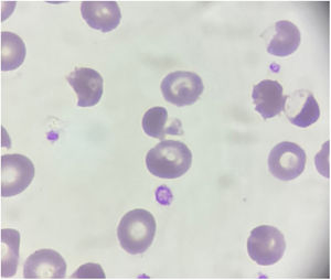 Frotis de sangre periférica con picnocitos y célula en ampolla (aumento original: 1000x).