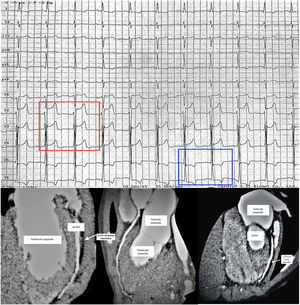 Panel superior. La imagen corresponde a ECG realizado en el momento de parar la ergometría por clínica de dolor torácico a los 8 minutos de su comienzo. En él se puede ver elevación de segmento ST de 3 mm en derivaciones V2-V3 y de 1 mm en V4 (recuadro rojo para V2-4), junto a descenso de ST de 1-2 mm con inversión de onda T en derivaciones V5 y V6 (recuadro azul para V5-6), compatible con isquemia en territorio irrigado por arteria coronaria descendente anterior (ACDA). Hubo normalización completa tras 4 minutos en reposo. Panel inferior. La imagen corresponde a 3 proyecciones diferentes de un mismo angio tomografía computarizada coronario en el que se objetiva puente miocárdico de 8 mm de longitud y espesor de 4,5 mm en el segmento medio de la ACDA, que es señalado por flechas blancas. Puede observarse cómo la ACDA deja de tener un recorrido epicárdico y es englobada por el miocardio del ventrículo izquierdo en las diferentes proyecciones aportadas. El resto de la anatomía coronaria era normal.