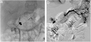 Arteria gastroduodenal, se observa irregularidad de su pared lateral antes de continuar con la gastroepiploica. Se realiza embolización con espirales metálicas.