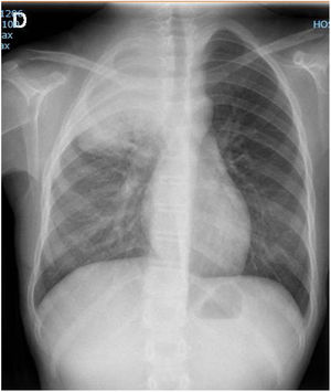Radiografía de tórax. Aumento de densidad homogéneo afectando a segmentos apicales y posteriores de lóbulo superior derecho con broncograma aéreo central.