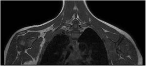RM. Se visualiza tejido pseudotumoral residual versus fibrocicatricial en la pleura apical derecha y musculatura retrosomática torácica superior derecha.