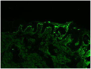 Inmunofluorescencia directa para inmunoglobulina A: depósitos lineales de IgA en la unión dermo-epidérmica.