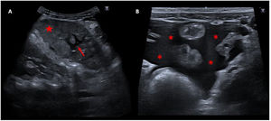 Ecografía abdominal del hipocondrio izquierdo. A) La imagen muestra un bazo de tamaño aumentado (13mm) para la edad del paciente, con ecogenicidad heterogénea (flecha roja). También se visualizaron áreas focales con bordes hipoecoicos bien definidos dentro del bazo (flecha roja) resultantes de la isquemia. B) La imagen muestra una acumulación moderada de líquido libre en la cavidad abdominal (asteriscos rojos).