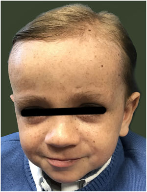 Facies del paciente a los 2 años de vida.
