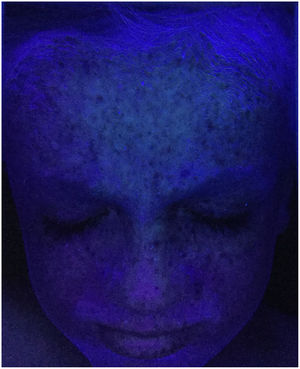 Lesiones producidas por la radiación solar visualizadas con luz ultravioleta (imagen cortesía de Javier del Boz González).