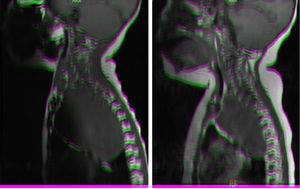 Resonancia magnética (RM) de paciente con debut de neuroblastoma con compresión medular. a) Masa mediastínica superior izquierda de diámetro 7 x 5 x 9 cm que comprime la médula ósea desde nivel C7-T1 hasta T3-T4. b) RM tras administración de ciclo etopósido-carboplatino: masa 5 x 5 x 8 cm, cuyo componente intracanal ha disminuido, observando menos efecto masa sobre el cordón medular, que recobra tanto su grosor como su intensidad de señal.