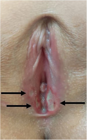 Examen físico al ingreso: tres úlceras vulvares, la más prominente de 12 mm, con borde rojo-violáceo y base necrótica profunda en el labio menor izquierdo, y las otras dos, más pequeñas, en el lado opuesto (lesiones «en beso»).
