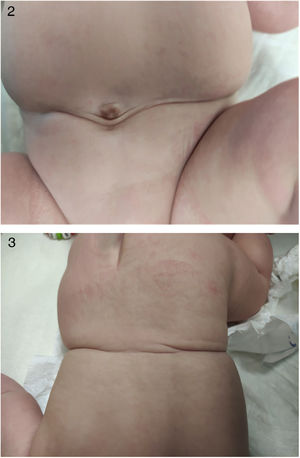 Tracto fibroso que rodea toda la circunferencia abdominal secundario a brida amniótica.