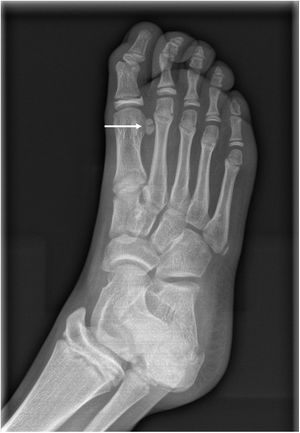 Radiografía de pie derecho. Sesamoideo lateral bipartito.