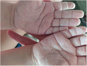 Se aprecia la presencia de lesiones blanquecinas en las palmas de ambas manos al contacto con el agua.