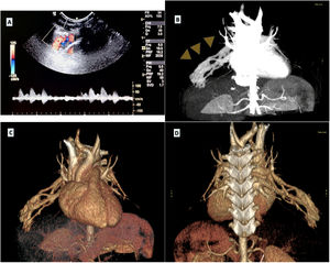 Malformación arteriovenosa (MAV) pulmonar compleja en el lóbulo medio en un niño de 18 meses. (A) Ecografía torácica a pie de cama con señal Doppler aumentada a lo largo de la pared torácica derecha en la localización en la que se percibía el soplo durante la auscultación. (B) Angio-TC mostrando la MAV pulmonar (puntas de flecha). (C y D) Reconstrucción 3D de TC permitiendo la visualización de los aspectos anterior y posterior de una malformación arteriovenosa enrevesada, ilustrando su complejidad.