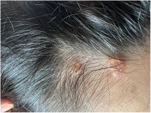 Lesiones vesiculoampollosas con impetiginización secundaria.