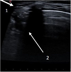 Ecografía pulmonar en el cuarto espacio intercostal de la línea media clavicular anterior. Visualizamos una imagen de desestructuración de la pleura (flecha1), con patrón de condensación (flecha2) y borde en sacabocados que ocupa un espacio intercostal con una profundidad de 1,2cm, compatible con neumonía incipiente.