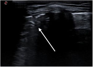 Ecografía pulmonar. Mismo patrón de condensación con broncograma (flecha).