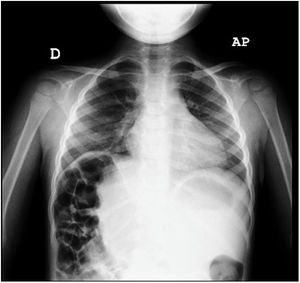 Radiografía posteroanterior de tórax. Vemos la interposición de asas entre el diafragma y el hígado, que está desplazado hacia la línea media. No se visualiza imagen de condensación.