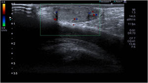 Testículo derecho de 0,9cc (similar al contralateral), heterogéneo en relación con antecedentes; se objetiva una adecuada perfusión en todo el parénquima. No se aprecia hidrocele ni otras alteraciones paratesticulares.