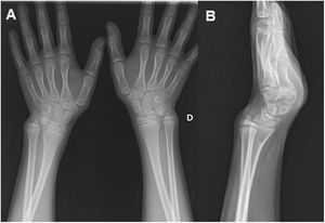 Radiografía de muñecas anteroposterior (A) y lateral de muñeca izquierda (B): dudosa desviación de la epífisis radial distal y acuñamiento del carpo.