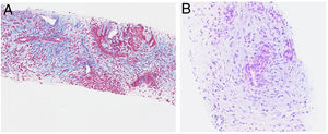 Histología pancreática. A)Imagen ×10 aumentos en la que se objetiva fibrosis (tricrómico de Masson). B)Imagen ×20 aumentos en la que se objetiva infiltración de los ductos por polimorfonucleares neutrófilos (hematoxilina/eosina).
