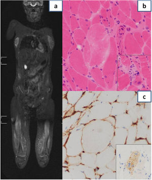 a: Resonancia magnética nuclear que muestra afectación muscular con patrón miofascial, parcheado, multifocal, bilateral y simétrico, con importante afectación de cuádriceps, isquiotibiales y aductores. b: Anatomía patológica de biopsia muscular: se aprecia variabilidad en el tamaño de las fibras musculares y una fibra necrótica centrada en la imagen sin inflamación significativa. El recuadro incluye una imagen de miofagocitosis. c: Anatomía patológica de biopsia muscular: se observa positividad sarcolémica focal de HLA-I. El recuadro muestra la positividad granular citoplasmática difusa frente a p62 en una fibra muscular.