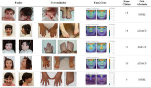Rasgos faciales y alteraciones en las extremidades en pacientes con SCdL y variantes patogénicas en diferentes genes causales. Se muestra también el análisis mediante el programa «Face2Gene» y los scores calculados según Kline et al3.