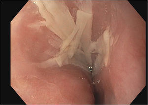 Esófago proximal (20cm arcada dentaria). Se observa mucosa descamada que ocupa ¼ de la circunferencia.