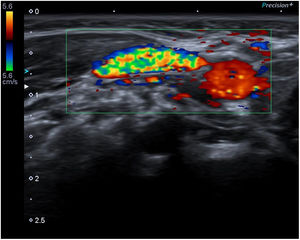 Ecografía Doppler color: presencia de flujo venoso y ausencia de trombos intraluminales.