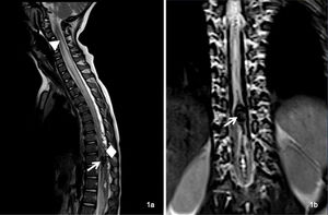 Resonancia magnética de la columna vertebral que revela una malformación arteriovenosa intramedular a nivel de D10 (flecha), caracterizada por ectasia y hematomielia. La hematomielia aparecía con hipointensidad en imágenes ponderadas en T2, extendiéndose a través del conducto ependimario en sentido cefálico hasta D9 y en sentido caudal hasta el cono medular. A la vez, se observó hiperintensidad intramedular extensa hasta C2, atribuida a congestión venosa (triángulo), así como dilatación de las venas perimedulares posteriores (rombo).