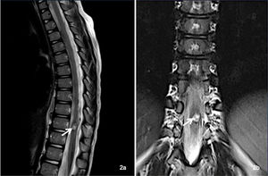 El seguimiento tras el tratamiento endovascular reveló una intensidad de señal heterogénea en secuencia a nivel de D10, indicando la presencia de material embólico y un trombo intravascular postratamiento (flecha). Se observó hemosiderina residual en la médula espinal, atribuida a sangrado previo. También se apreció reabsorción del edema, sin dilatación de las venas perimedulares posteriores u otras alteraciones vasculares.