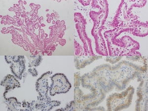 Estudio anatomopatológico. Lesión papilar revestida por células cúbicas con citoplasma eosinofílico y núcleos de cromatina fina (tinción con hematoxilina eosina ×20 arriba a la izquierda y ×40 arriba a la derecha). Se aprecia positividad para racemasa (abajo a la izquierda) y PAX8 (abajo a la derecha).