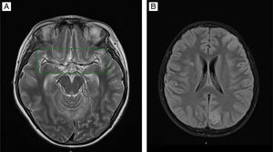 RM craneal secuencia T2 horizontal donde se aprecia: A) Alteración de señal en surcos a nivel supratentorial. B) Alteración de señal con restricción patológica de epéndimo ventricular de ambas astas occipitales y tercer ventrículo, mínimo del cuarto, así como algo de contenido purulento declive en ambas astas occipitales.