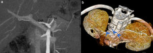Niña de 6 años con coartación de la aorta. Patrón anatómico normal del tronco celíaco (tipo 1) en imágenes MIP (a) y de RV 3D (b) en el plano coronal. CHA: arteria hepática común; LGA: arteria gástrica izquierda; SA: arteria esplénica.