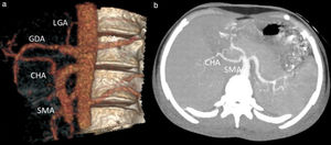Mujer adolescente de 16 años con agenesia de la arteria pulmonar. Visualización de tronco gastroesplénico en imágenes RV 3D (a) e imágenes MIP en el plano axial (b), así como de arteria hepática común con origen en la arteria mesentérica superior. CHA: arteria hepática común; GDA: arteria gastroduodenal; LGA: arteria gástrica izquierda; SA: arteria esplénica. SMA: arteria mesentérica superior.