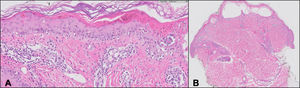 A) Desprendimiento dermoepidérmico con vesiculación y necrosis de toda la epidermis (magnificación ×20×). B) Dermatitis de interfase con vacuolización basal y queratinocitos apoptóticos (magnificación ×1).