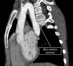 TC sagital. Arco aórtico alto por encima del nivel clavicular.