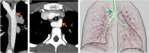 (A) TC coronal (B) TC axial que muestran el divertículo de Kommerell (flecha naranja) y su relación con la tráquea (T). (C) Reconstrucción 3D del árbol traqueobronquial donde se muestra la compresión que el AAC ejerce sobre la tráquea (flecha verde).