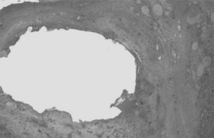 Aspecto histológico de blastoma pleuropulmonar. Tumor bifásico, componente quístico y sólido sarcomatoso con áreas hemorrágicas y necróticas interpuestas (tinción hematoxilina-eosina, ×10).