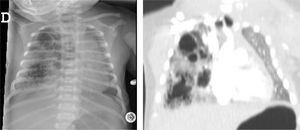 Imágenes radiológicas (radiografía simple y TC torácicas) de paciente con clínica respiratoria y necesidad de soporte ventilatorio. Se aprecia gran ocupación quística del hemitórax derecho compatible con MCVAP tipo 2 dependiente del lóbulo medio.